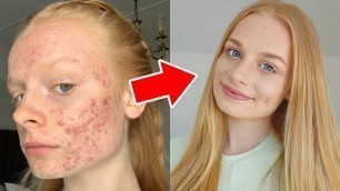 'HOW I COVER MY ACNE grwm + tutorial'
