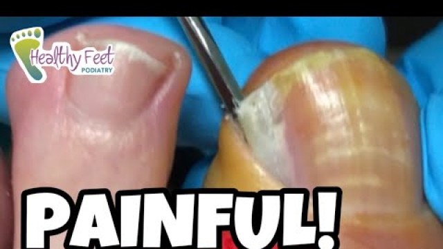 'SO PAINFUL AND SO SATISFYING WHEN THE INGROWN TOENAIL IS REMOVED!'