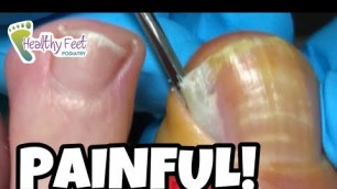 'SO PAINFUL AND SO SATISFYING WHEN THE INGROWN TOENAIL IS REMOVED!'