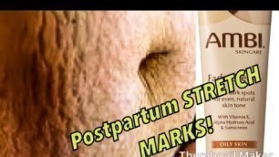 GET RID OF STRETCH MARKS WITH Ambi Fade Cream!