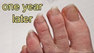 'Repainting my Toe Nails After 1 Year of Growing Them Out'