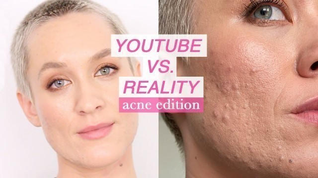 'Youtube vs. Reality Acne Edition | Makeup Can\'t Save You | Acne Just Sucks | Kiki G.'