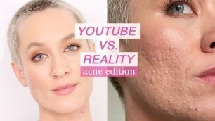 'Youtube vs. Reality Acne Edition | Makeup Can\'t Save You | Acne Just Sucks | Kiki G.'