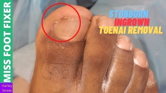 'Stubborn Ingrown Toenail Treatment | Miss Foot Fixer | Marion Yau'