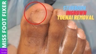 'Stubborn Ingrown Toenail Treatment | Miss Foot Fixer | Marion Yau'