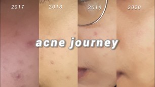 my acne journey | skincare routine for acne-prone & sensitive skin