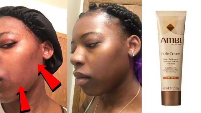 HOW TO FADE ACNE SCARS ft. AMBI Fade Cream