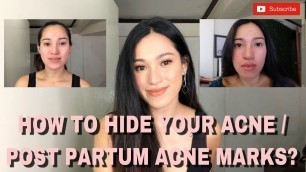 HOW TO HIDE YOU ACNE/  POST PARTUM ACNE MARKS  | Quick and easy  On-the-Go Makeup tutorial