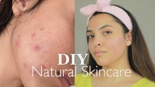 HOW TO CLEAR ACNE NATURALLY | DIY NATURAL SKIN CARE | DIY MOISTURIZER , SERUM ,TONER ,SCRUB FOR FACE