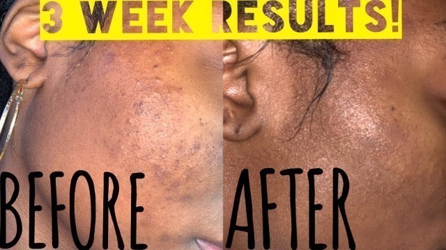 How to fade dark spots FAST| Controlling Breakouts
