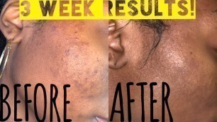 How to fade dark spots FAST| Controlling Breakouts