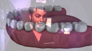 Implant Dentistry Orlando FL Dental Implants Altamonte Springs