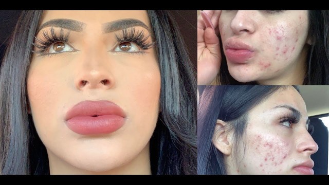 Full-Coverage Acne Makeup-Tutorial!TIPS YOU NEED TO KNOW!