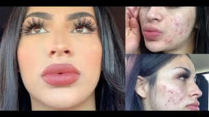 Full-Coverage Acne Makeup-Tutorial!TIPS YOU NEED TO KNOW!