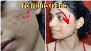 Skincare routine for oily /acne prone/ combination skin | Plum Green tea range review