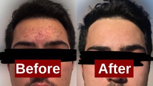 ACNE BEFORE AND AFTER | Acne Skincare Routine| Clearing My Brother's Acne in 30 Days | Razia Moe