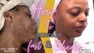 How To| SkinCare Routine *DARK MARKS/ACNE GONE --Fast (in 3 weeks) and Cheap (under 50 bucks)!!!