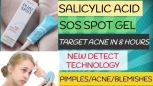 #acne#pimples#blemishes #skincareroutine #oilyskincare #salicylicacid Spot Gel for acnes prone skin.