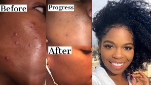 My Acne Prone Skincare Routine: How I cleared up My Acne/Discoloration FT. Ambi