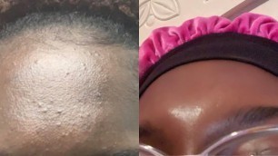 Skincare Routine: HOW I CLEARED MY HYPERPIGMENTATION, ACNE, DARK SPOTS AND SCARS | HEALTHY SKIN