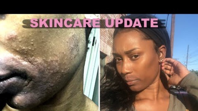 SKIN CARE UPDATE: ALLERGIC REACTION & HYPER-PIGMENTATION?