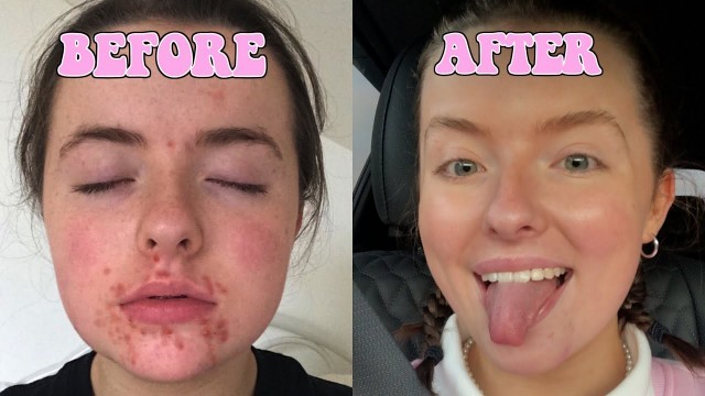 HOW I GOT RID OF MY ACNE & ACNE SCARS // AFFORDABLE SKINCARE ROUTINE // CLEARING MY HORMONAL ACNE