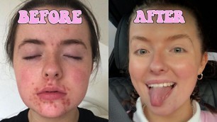 HOW I GOT RID OF MY ACNE & ACNE SCARS // AFFORDABLE SKINCARE ROUTINE // CLEARING MY HORMONAL ACNE