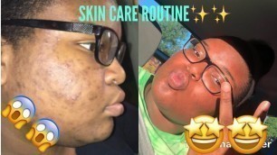 HOW I GOT RID OF MY ACNE AND DARK SPOTS IN A MONTH!!! | SKIN CARE ROUTINE✨