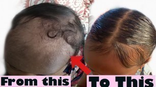 How to get rid of/remove cradle cap!! ( And grow your baby hair back)