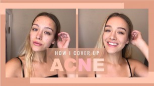Makeup Tutorial: Covering Up Acne