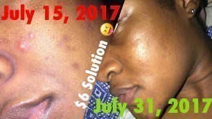 Fade Acne Scars Fast with $6!