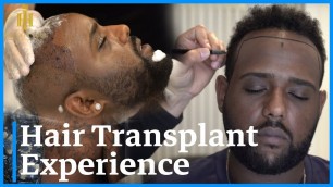 Hair Transplant Experience: Afro-American Guest from Los Angeles