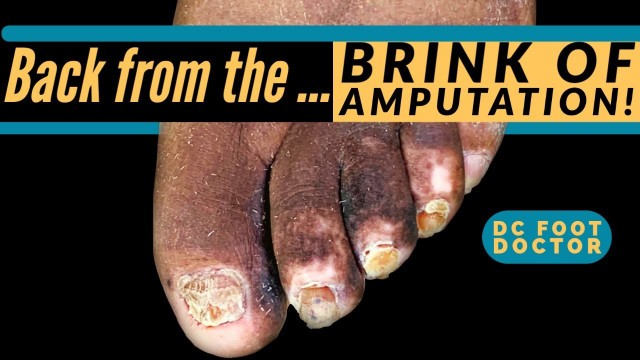 'Back from the Brink of Amputation: Diabetic Toenail and Skin Care After Complete Wound Healing'