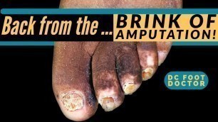 'Back from the Brink of Amputation: Diabetic Toenail and Skin Care After Complete Wound Healing'